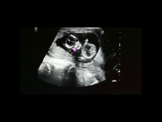que es ultrasonido obstetrico trim ii y iii