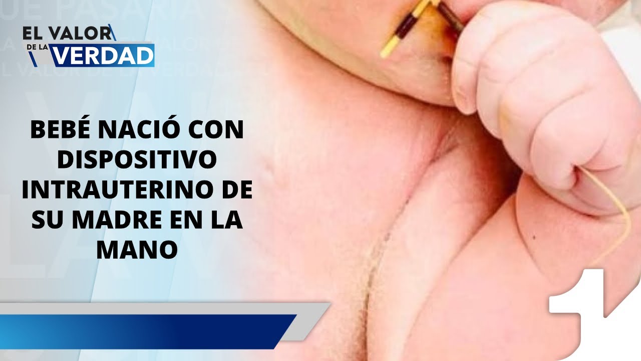 bebe con diu en la cabeza