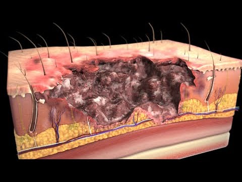 epidemiologia de quemaduras a nivel mundial