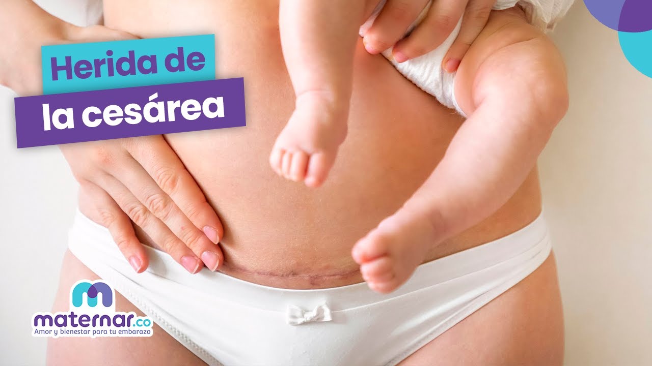 puedo lavar trastes despues de una cesarea